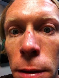 Photo of Close Up of My Nasal Trauma