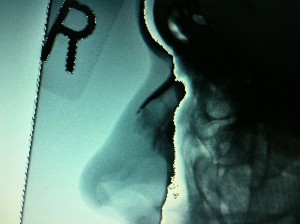 Photo of Radiographic Evidence of Fracture to Tip of My Nasal Bone